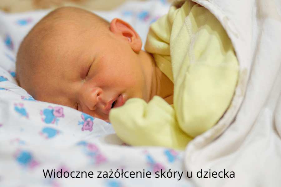 Zażółcenie skóry u noworodka